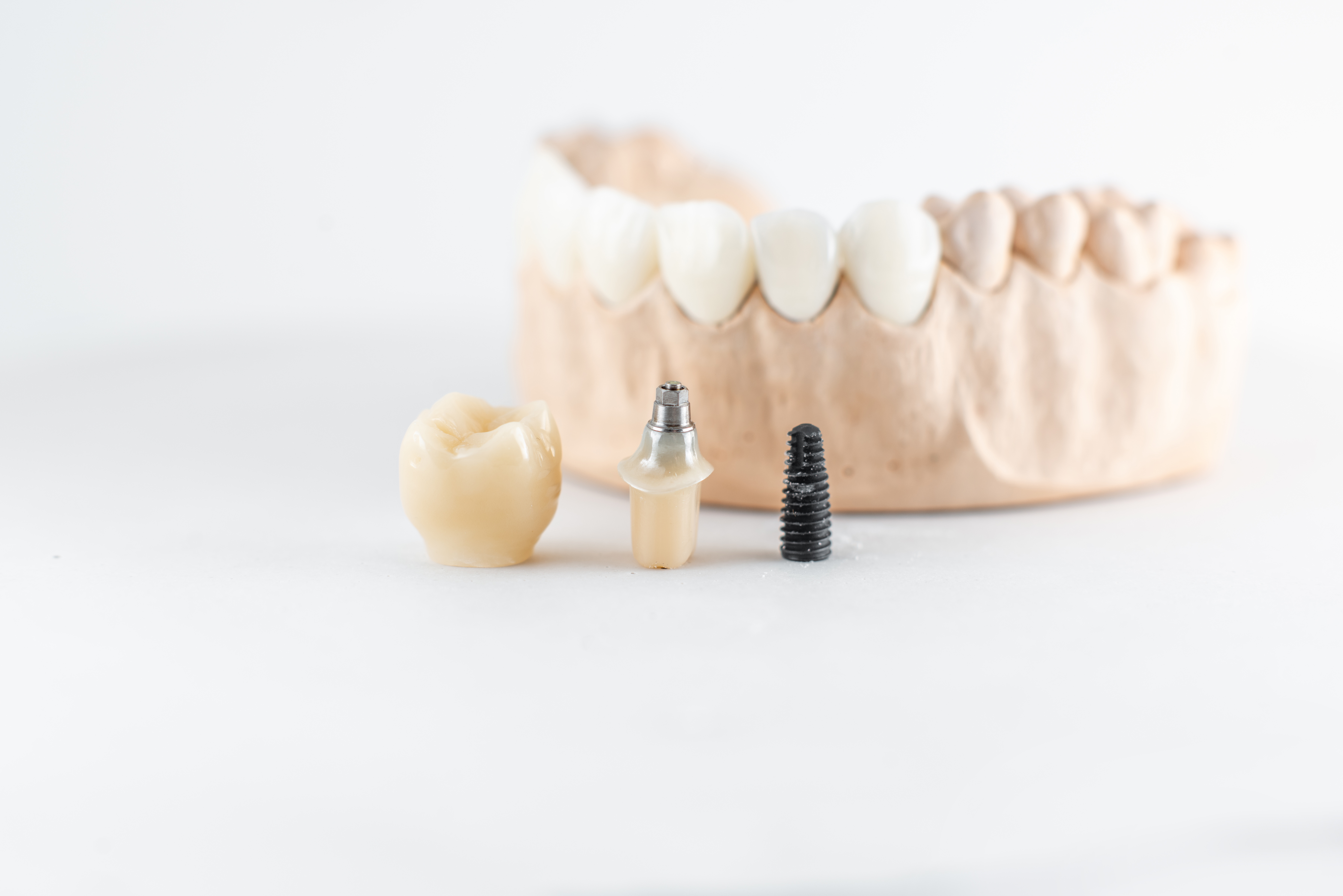 Close-up on plaster model of artificial jaw and dental implant on the white background. Concept of prosthetics and implantation in dentistry